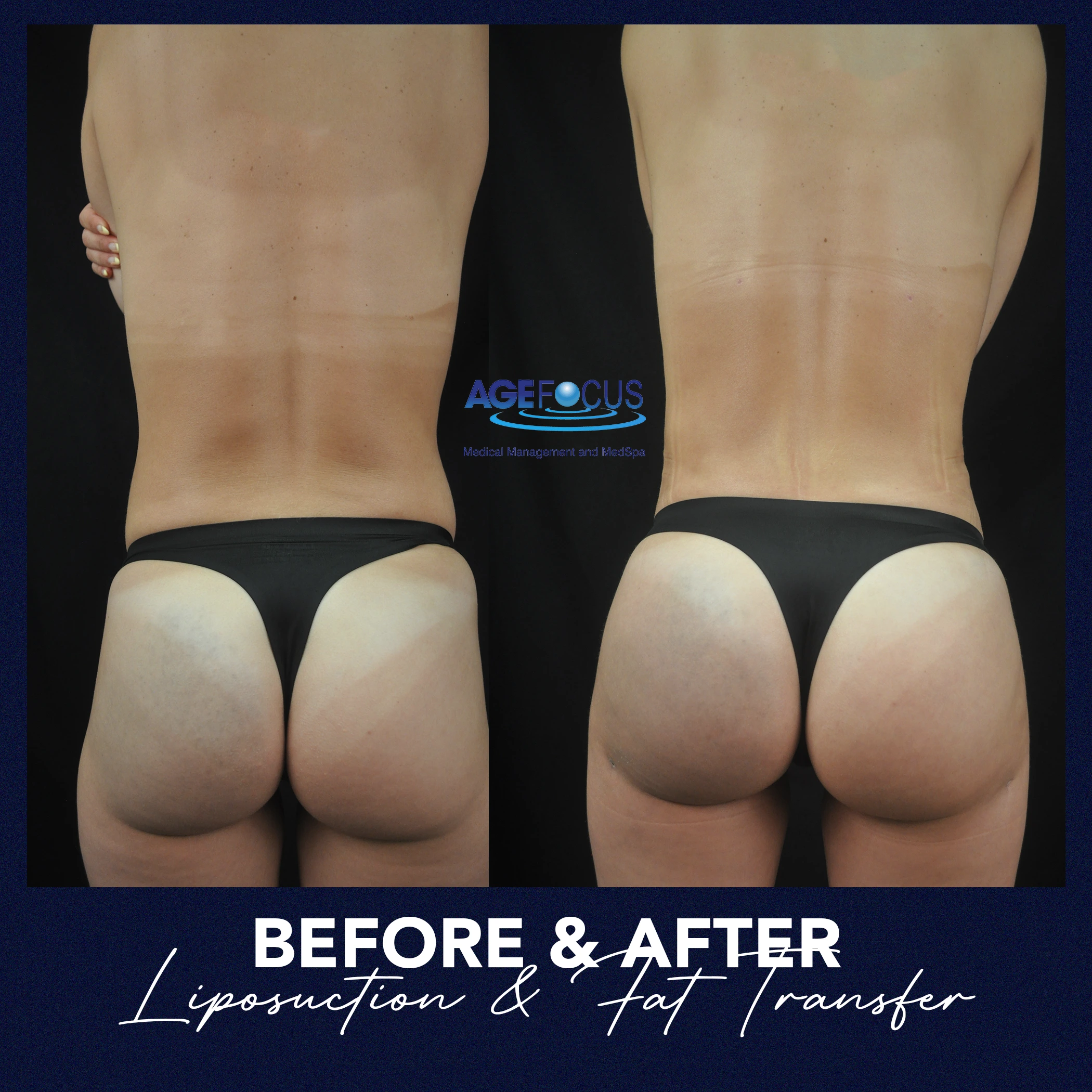 Before & After Liposuction