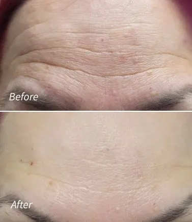 Botox for Forehead Lines