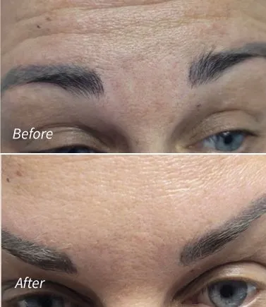 Botox for Forehead Lines(1)