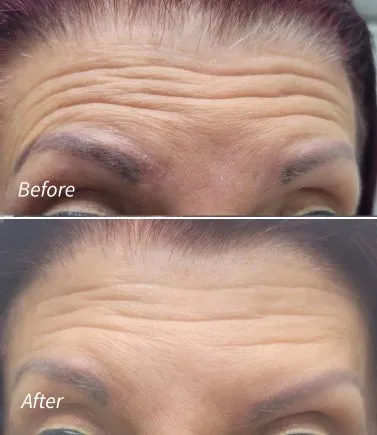 Botox for Forehead lines(2)