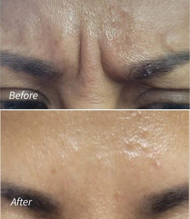 Botox for Frown Lines