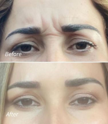 Botox(1)