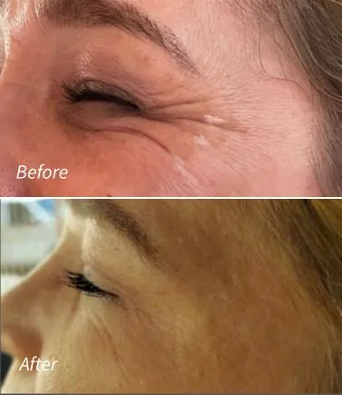 Botox(10)