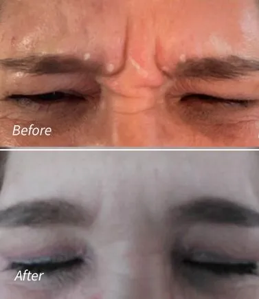Botox(11)
