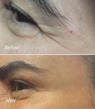 Botox(12)