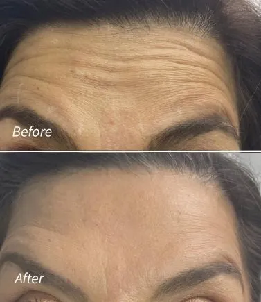 Botox(2)
