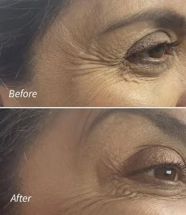 Botox(3)