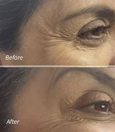 Botox(4)