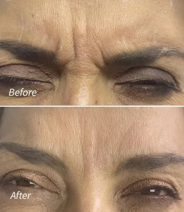 Botox(5)