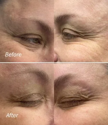 Botox(7)