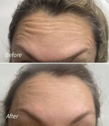 Botox(8)