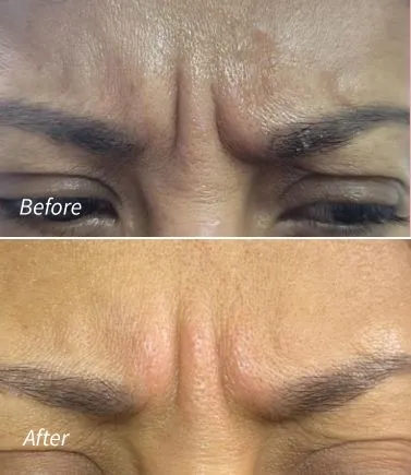 Botox(9)