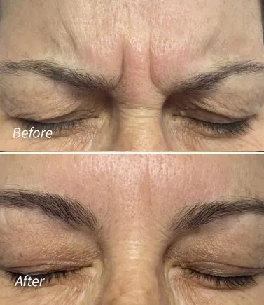 Botox