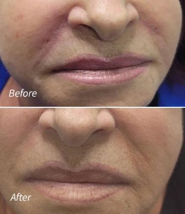 fillers for smile lines!