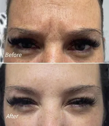 Jeuveau Botox