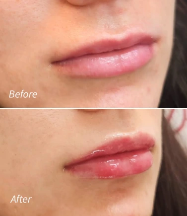 Lip Filler