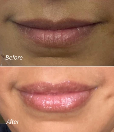 lIP FILLER(1)