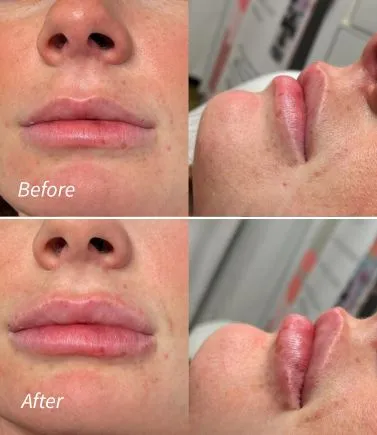 Lip Filler(1)
