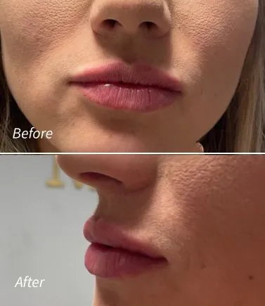 Lip Filler(2)
