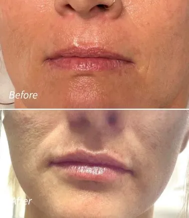 Lip Filler(3)