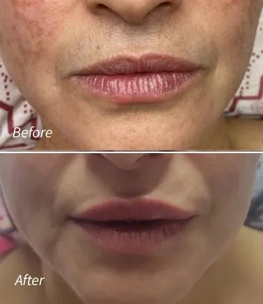 Lip Filler(5)