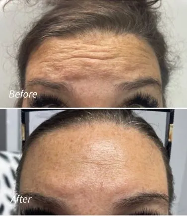 Lip Filler(7)