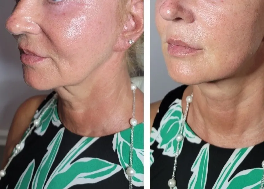 Face and neck-1