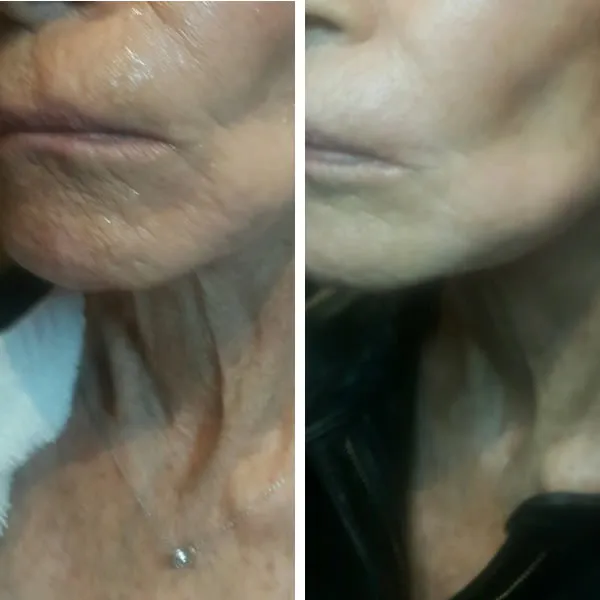 Face and neck-14