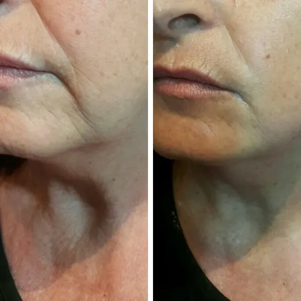 Face and neck-15