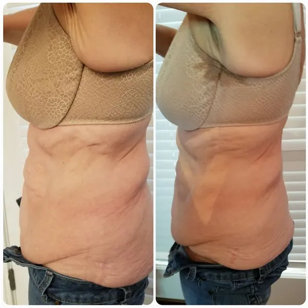 abs-3