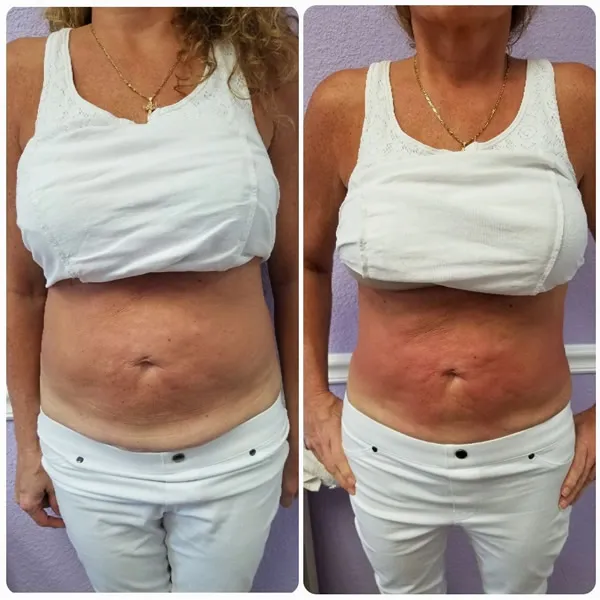 abs-4.1