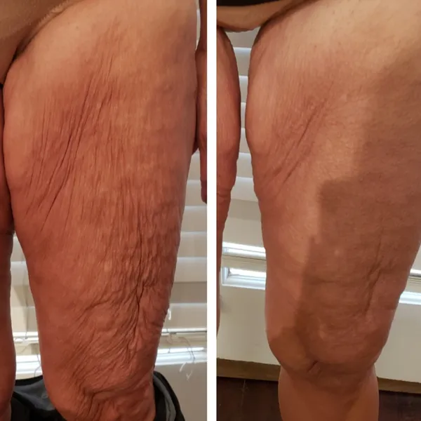 legs-and-thighs-5