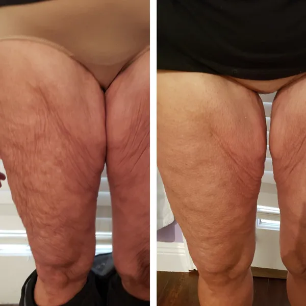 legs-and-thighs-8