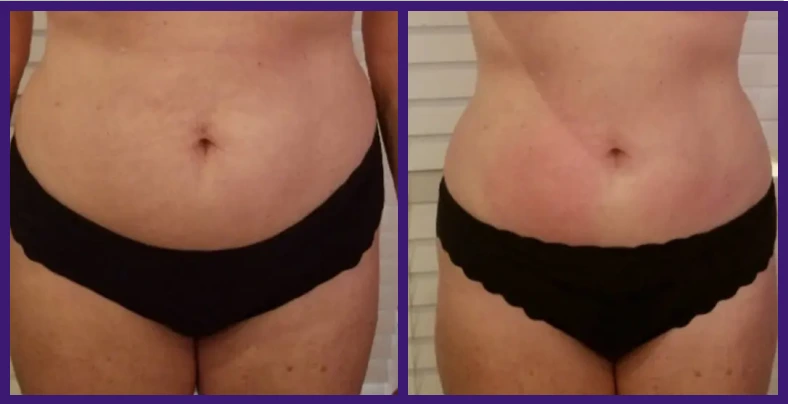 Non surgical Tummy Tuck Before & After Banner