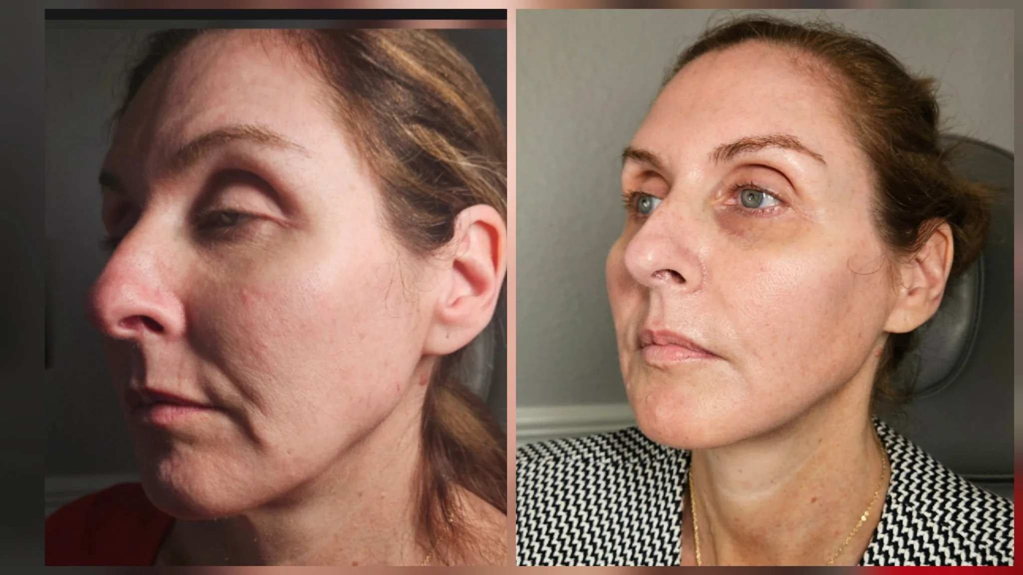 Before and after non-surgical facelift: smoother cheeks and a firmer jawline, three-quarter view