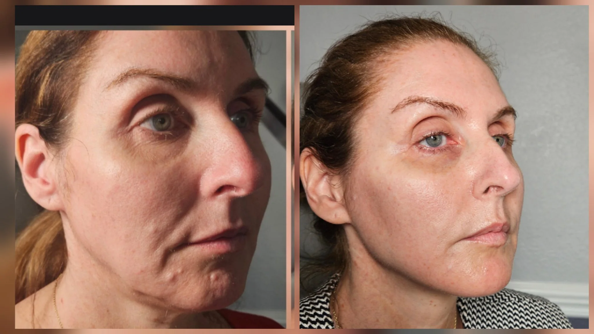 Before and after non-surgical facelift: softer smile lines and lifted lower face