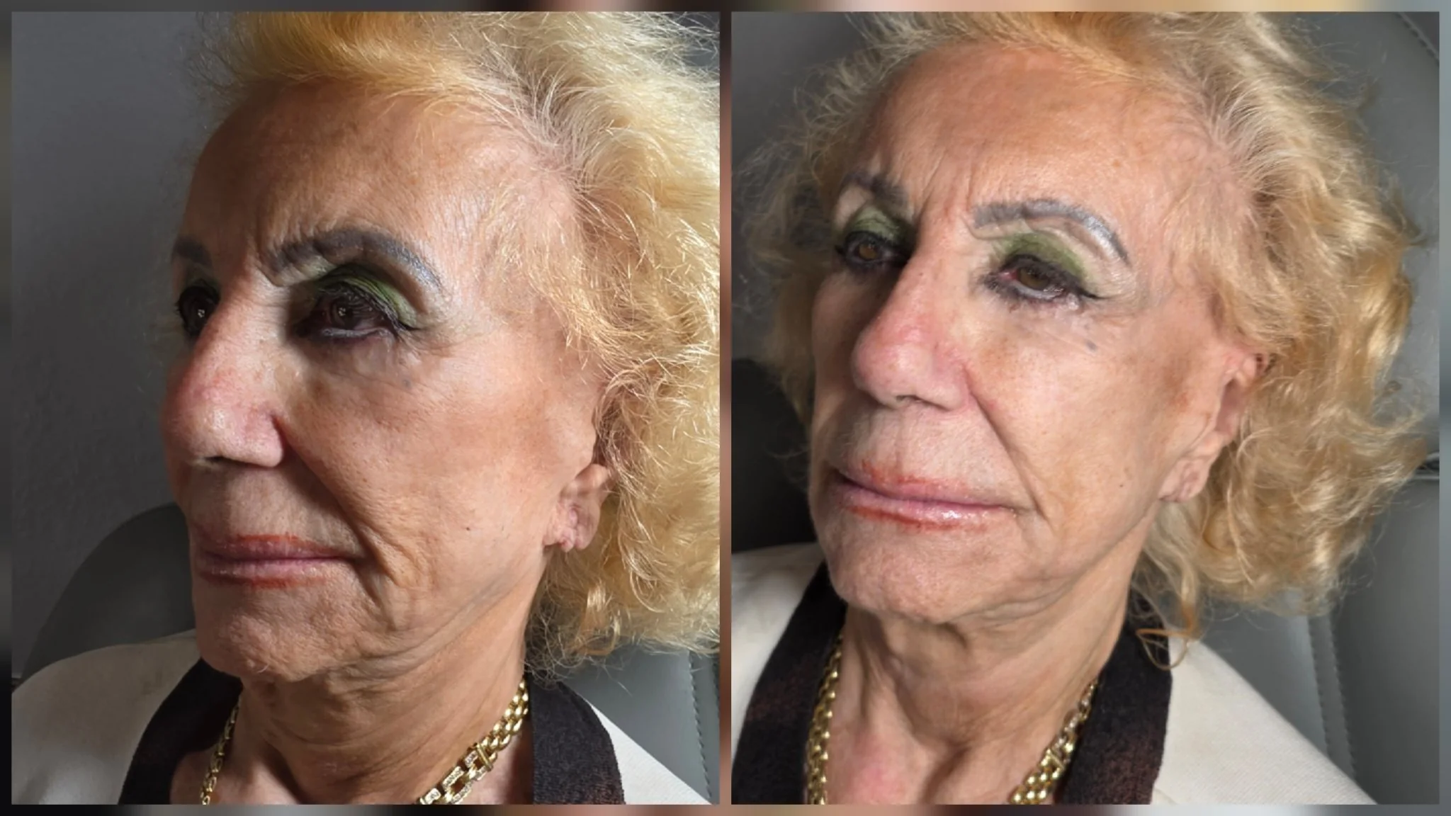 Before and after non-surgical facelift: lifted cheeks and smoother skin around the mouth