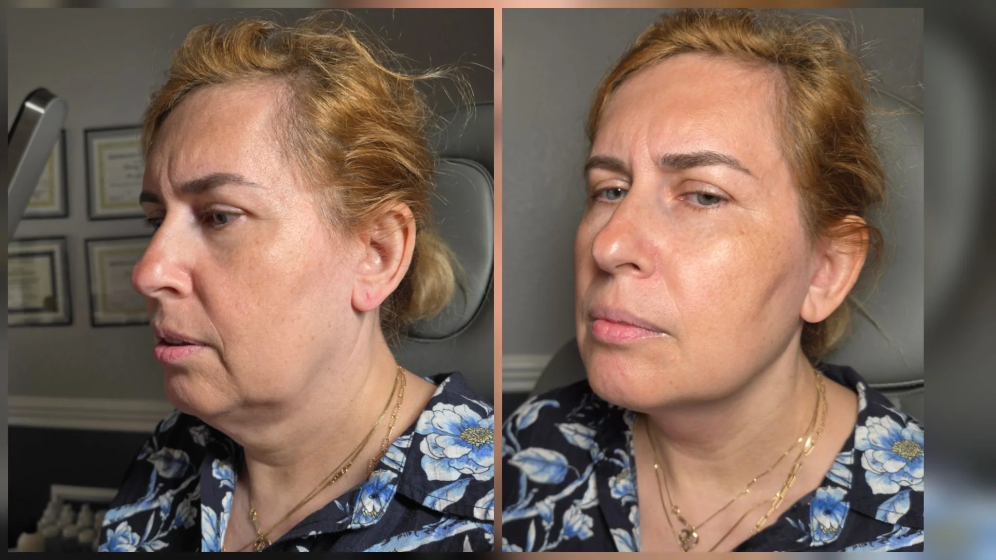 Before and after non-surgical facelift: lifted jowls and more defined jawline
