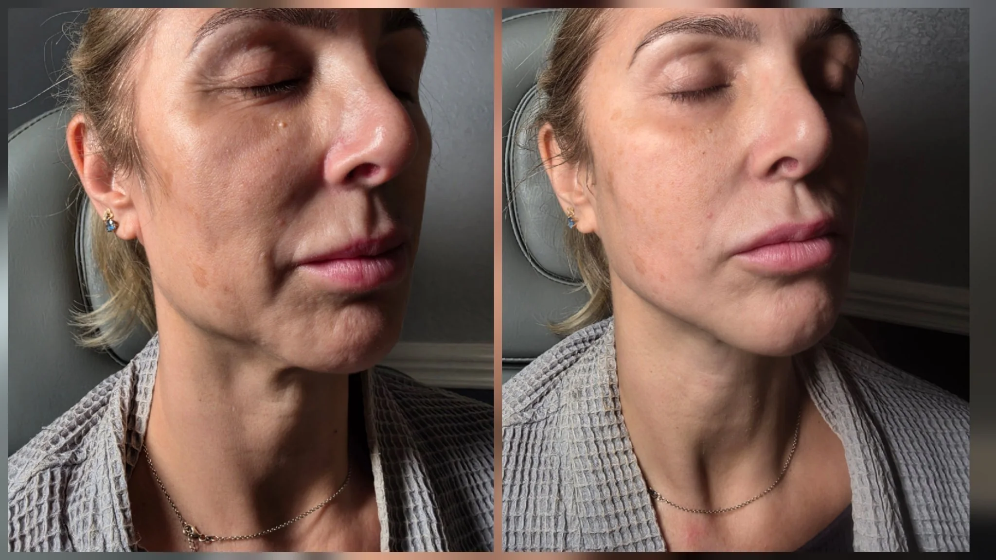Before and after non-surgical facelift: smoother cheek and tighter jaw contour