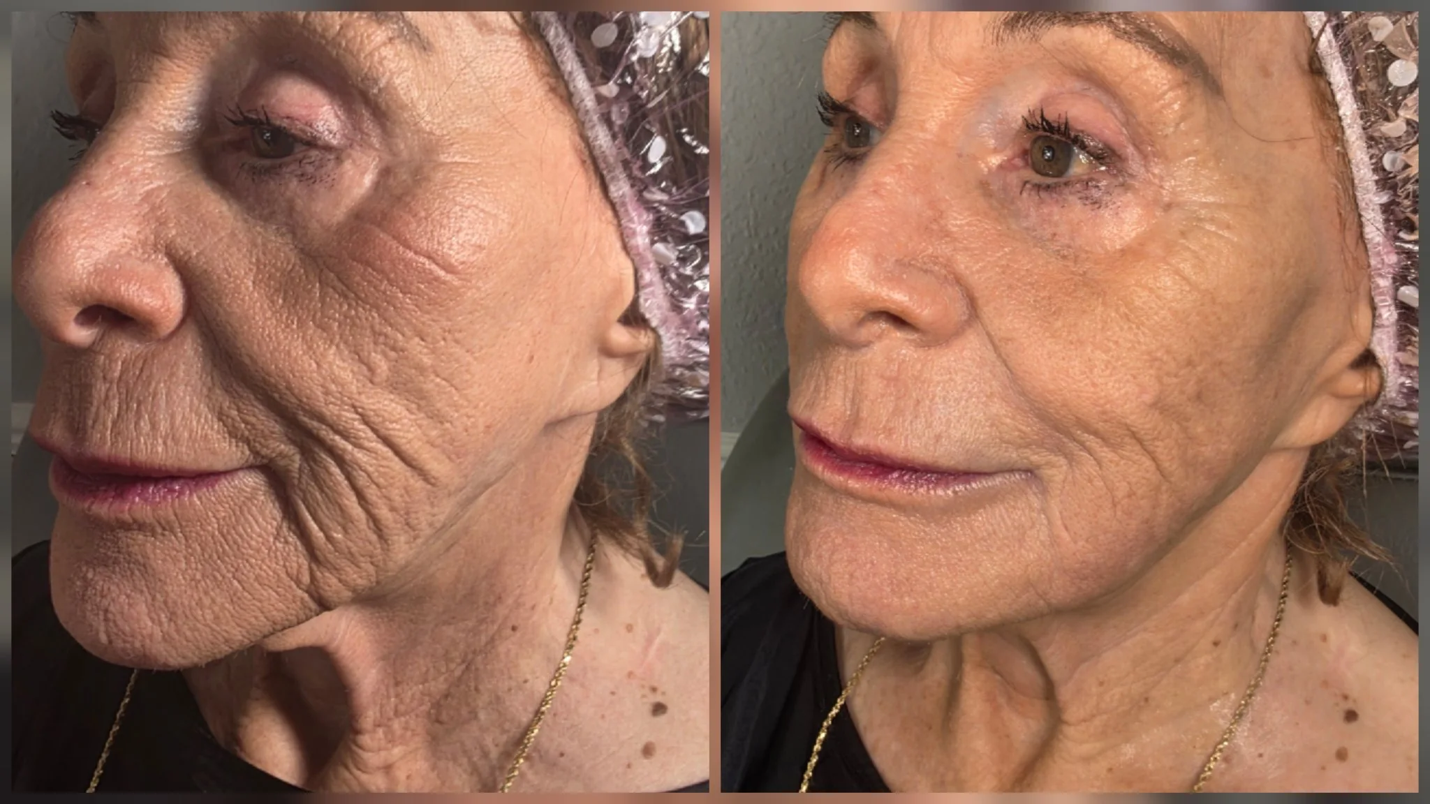 Before and after non-surgical facelift: reduced deep wrinkles on cheeks and around the eyes