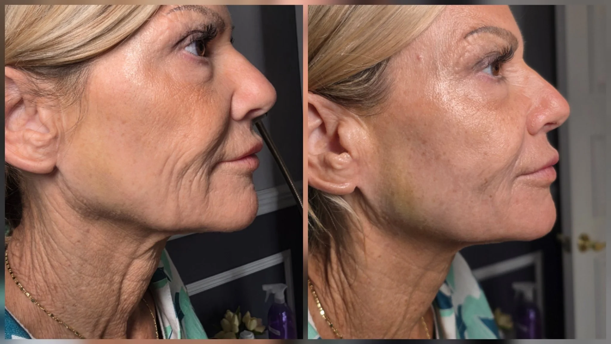 Before and after non-surgical facelift: smoother neck and cheek skin in side profile