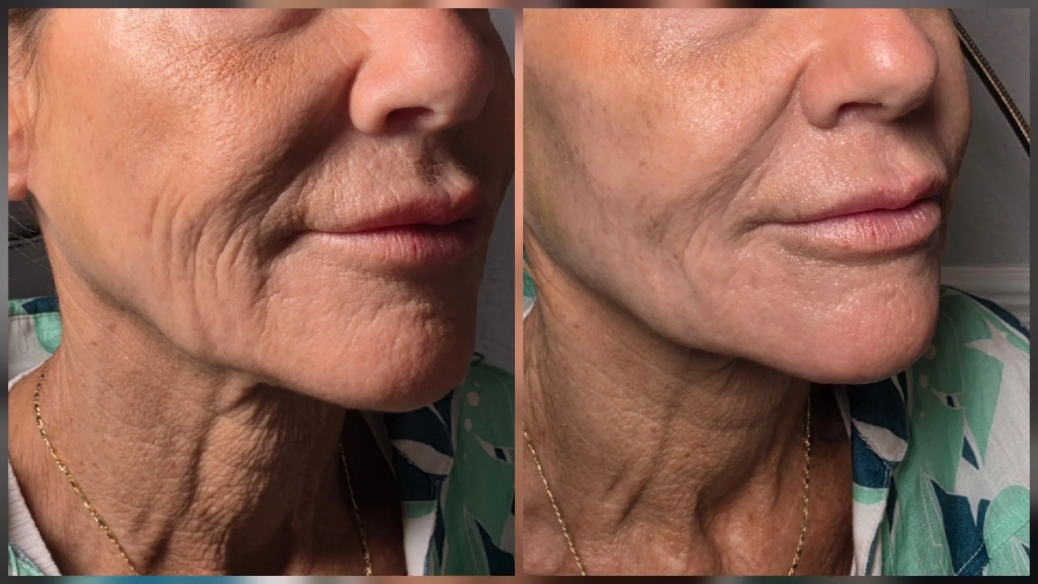 Before and after non-surgical facelift: softened lines around the mouth and firmer neck