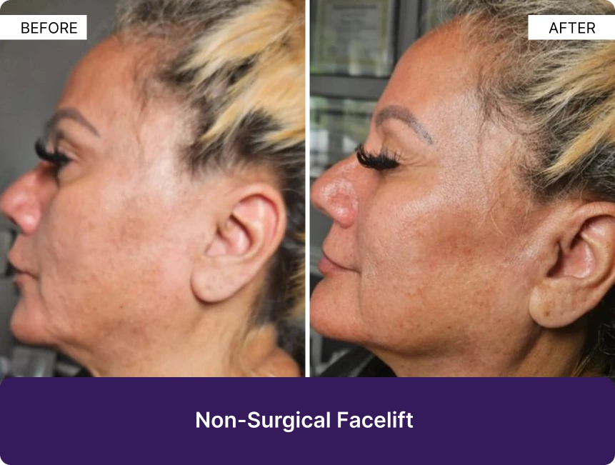 Before and after profile comparison of non-surgical facelift results showing improved jawline definition and skin texture