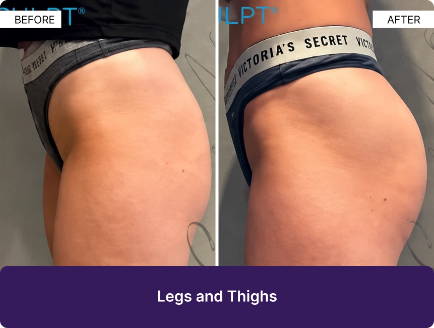 Before and after comparison of legs and thighs showing enhanced sculpting results