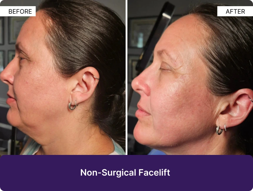 Side-by-side before and after profile views showing non-surgical facelift results with improved jawline definition and skin texture