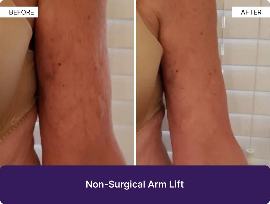 Before and after comparison of non-surgical arm lift showing reduced skin laxity and improved arm contour