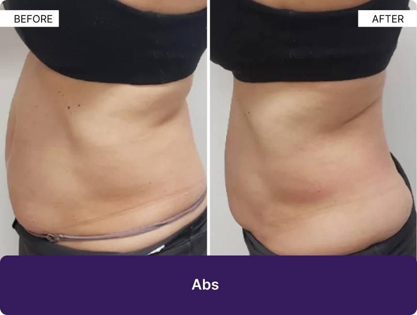 Before and after abdominal sculpting treatment showing reduced loose skin and improved abdominal contour