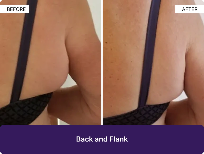 Before and after back and flank treatment showing improved skin texture and contour