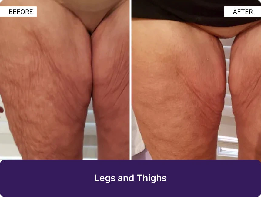 Before and after comparison of legs and thighs showing improved skin texture and tone