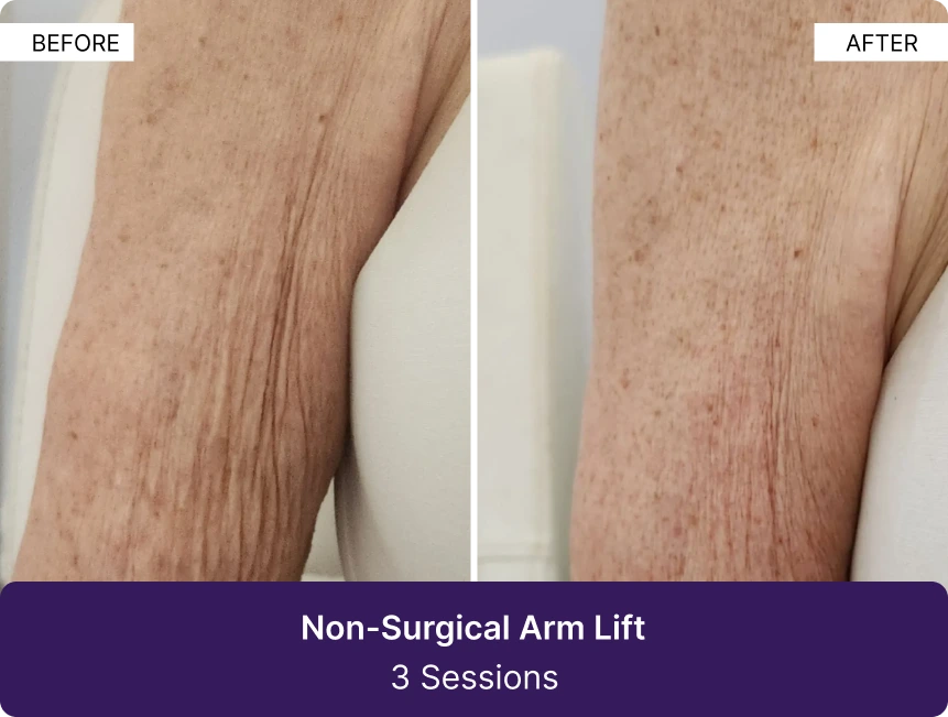 Before and after comparison of arm showing improved skin texture and reduced wrinkles after non-surgical arm lift treatment over 3 sessions